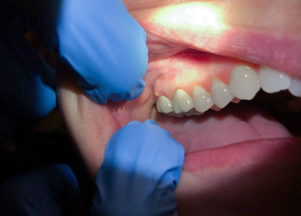 Best Emergency Dental Care for Sports Injuries in Jamestown, KY